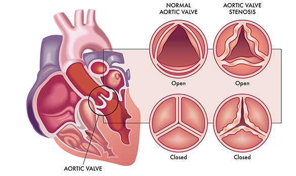 대동맥심장판막석회화증이란?