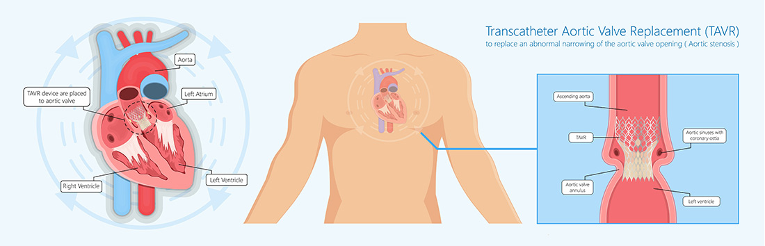 SAVR & TAVR