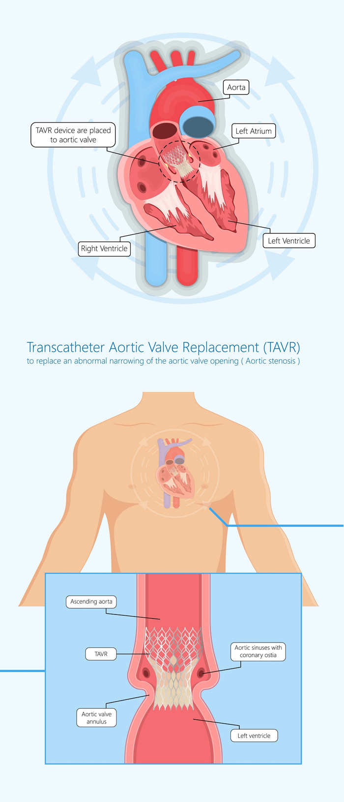 SAVR & TAVR